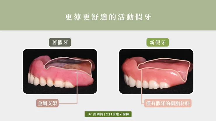 更薄更舒適的全口活動假牙