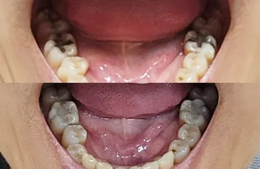 隱適美矯正紀錄 #除汞