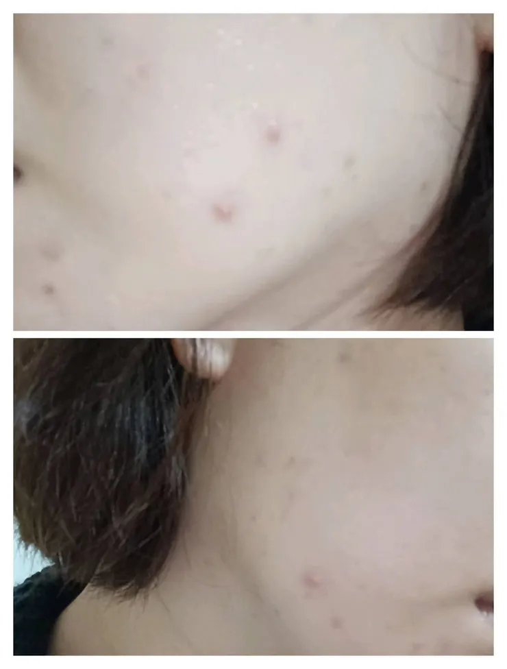 令人崩潰的大爆痘時期