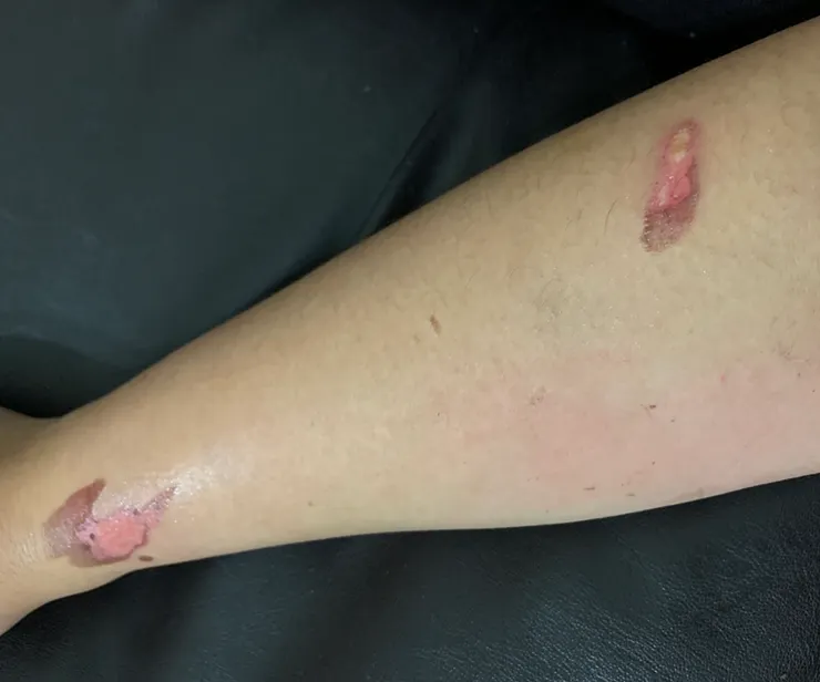 破皮發炎的傷口