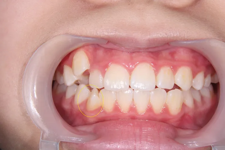 （妹妹）小虎牙，都集中在右邊，上下