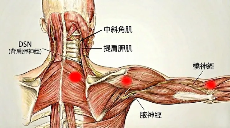 背肩胛神經、腋神經與橈神經皆有相同的神經根。當DSN受到壓迫時，可能產生「雙重壓迫症候群」，導致發炎物質傳遞，進而引起腋神經與橈神經支配區域的疼痛。