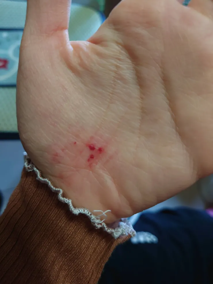 我的手也擦傷了