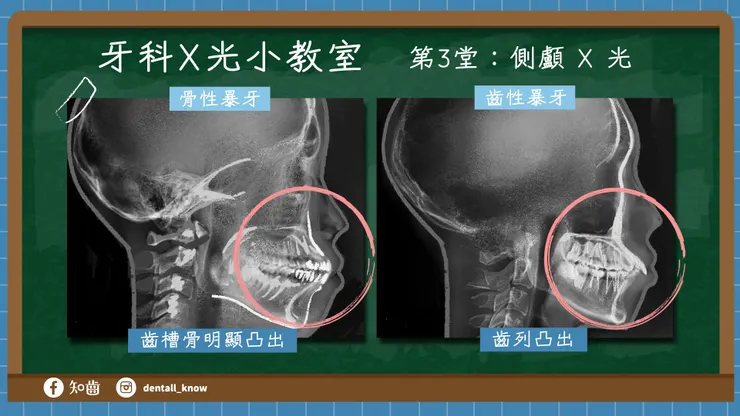 牙科 X 光小教室 第3堂：側顱 X 光