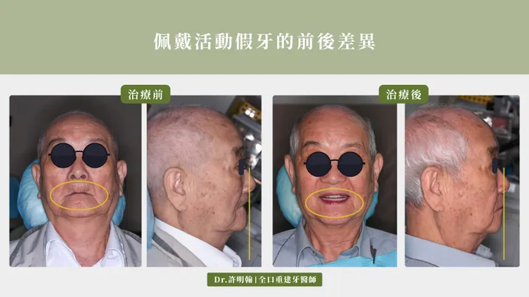 佩戴活動假牙的前後差異