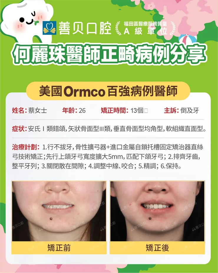 深圳正畸醫師何麗珠箍牙病例