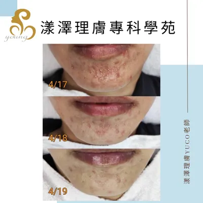 急性炎症護理-三日恢復不留疤