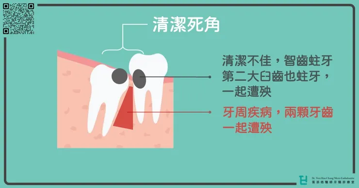 https://dentistry.tw/wisdomtooth3/