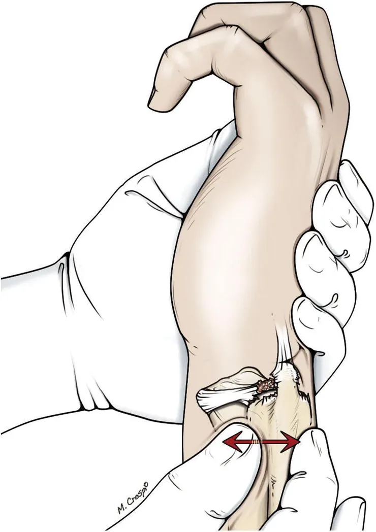 DRUJ Ballottement Test（關節滑動測試）示意圖