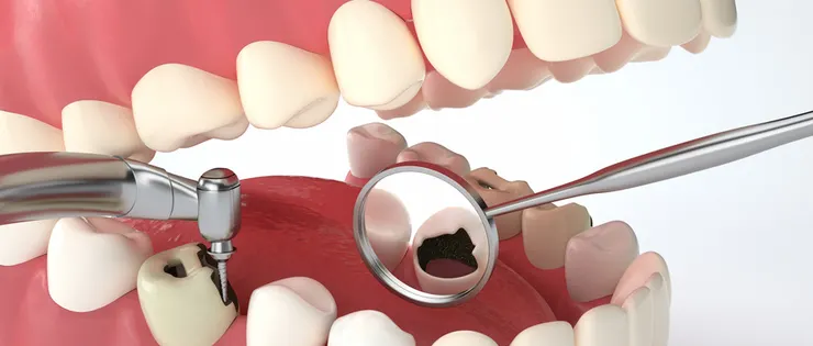 深圳補牙牙科排名