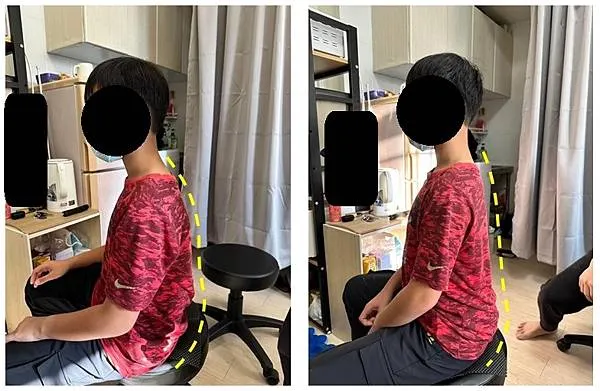 這位弟弟駝背關係,胸椎僵硬與長久坐姿影響,導致胸椎無法挺直坐正,即便用力壓背部也無法挺直,連帶出現頭前引或稱烏龜頸與肋骨緊繃下非常怕癢,經過一個小時的手法鬆解能自然坐正,過程中也花了一半時間在處理怕癢的影響)