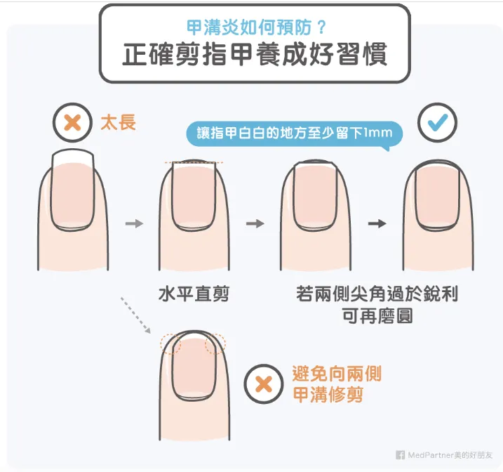 圖片來源：https://www.medpartner.club/paronychia-treatment-care-introduction/