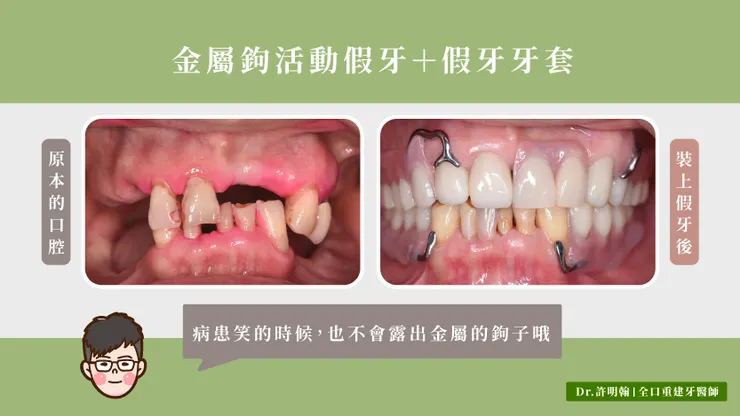 金屬鉤活動假牙＋全瓷冠假牙牙套