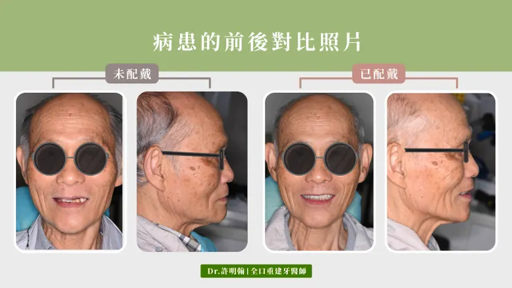 戴上活動假牙後的前後對比照片