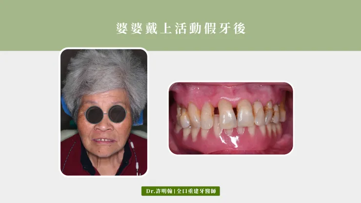 鈕扣式活動假牙 覆蓋式活動義齒