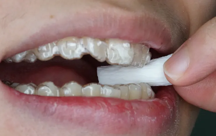 用棉捲固位隱形牙套