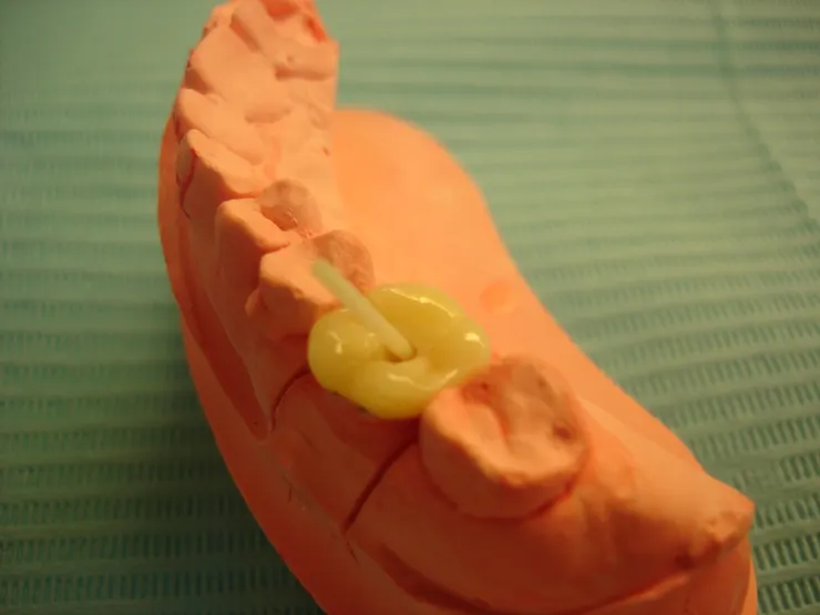 拔牙前的最後希望！牙齒的最後防線！渥爾牙醫用Cap-Lock技術守住天然牙！