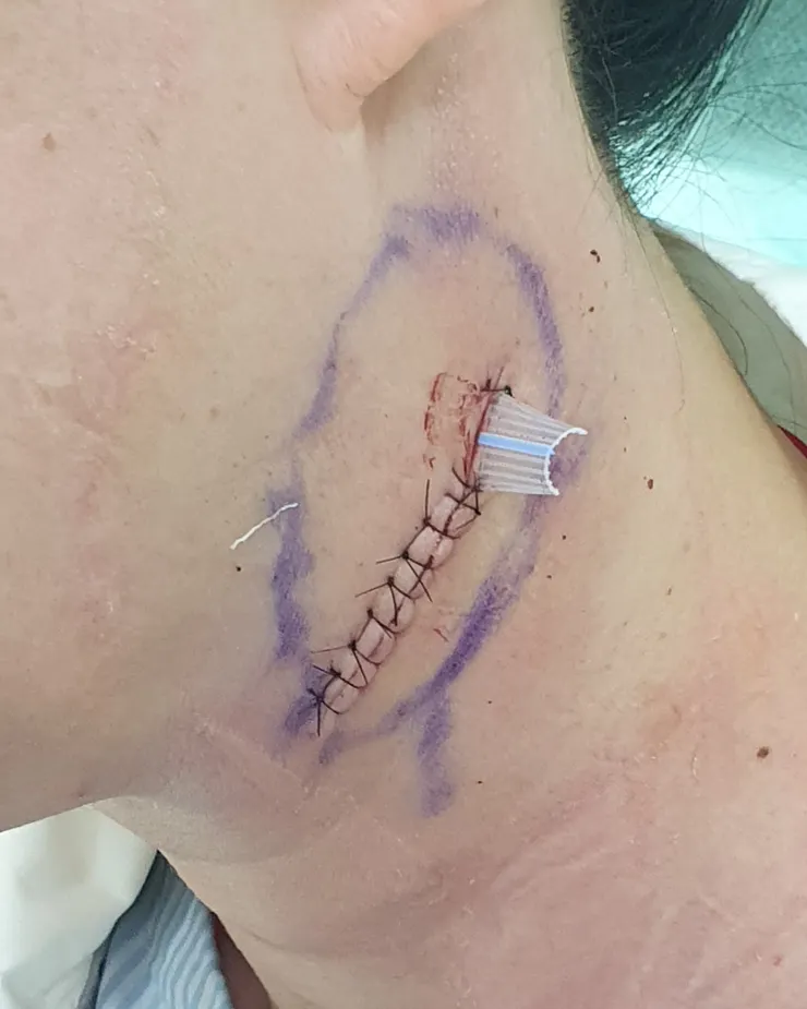 大約縫了 10 針左右