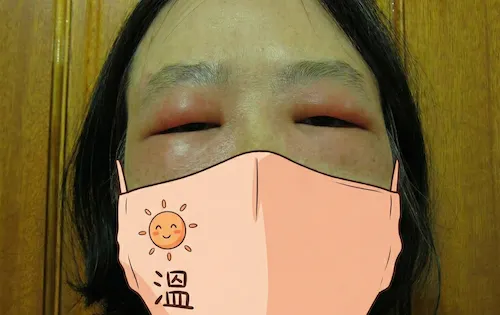 眼周紅腫第一天，臉腫得像豬頭