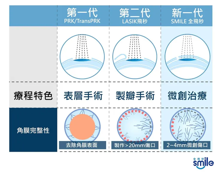 圖片來源：smile全飛秒近視雷射