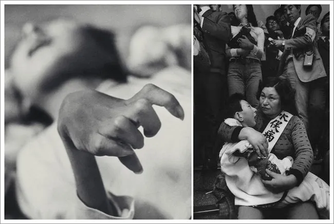 水俁病患者病況。