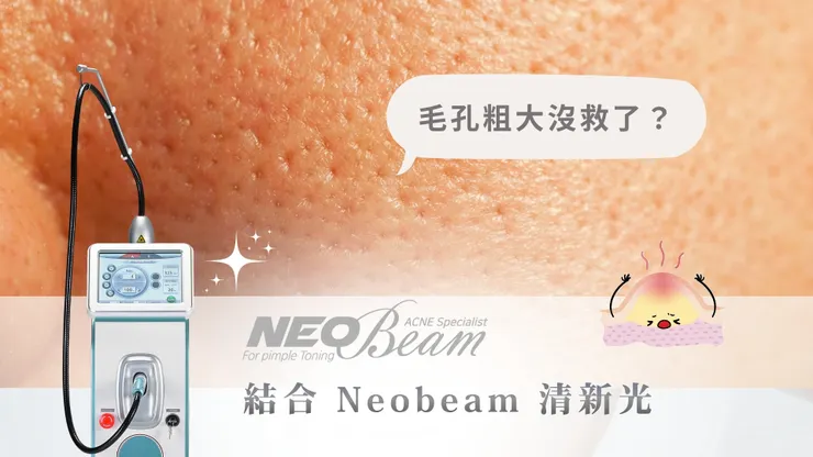 毛孔粗大沒救了?結合 Neobeam 清新光,打造「視覺無瑕」的縮毛孔計畫!