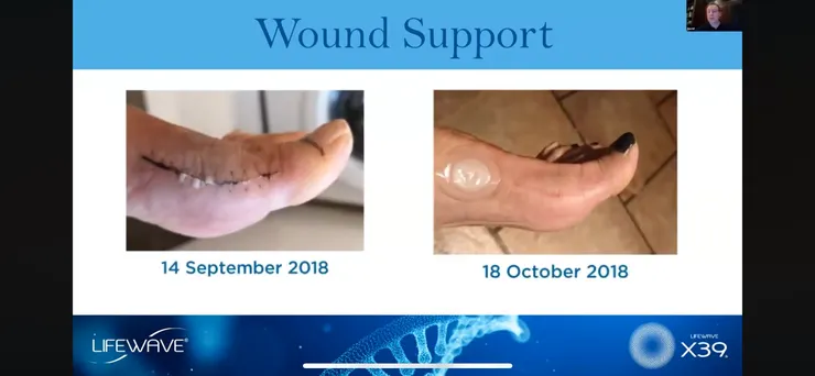 支持傷口復原：2018/09/14 -> 2018/10/18 使用X39