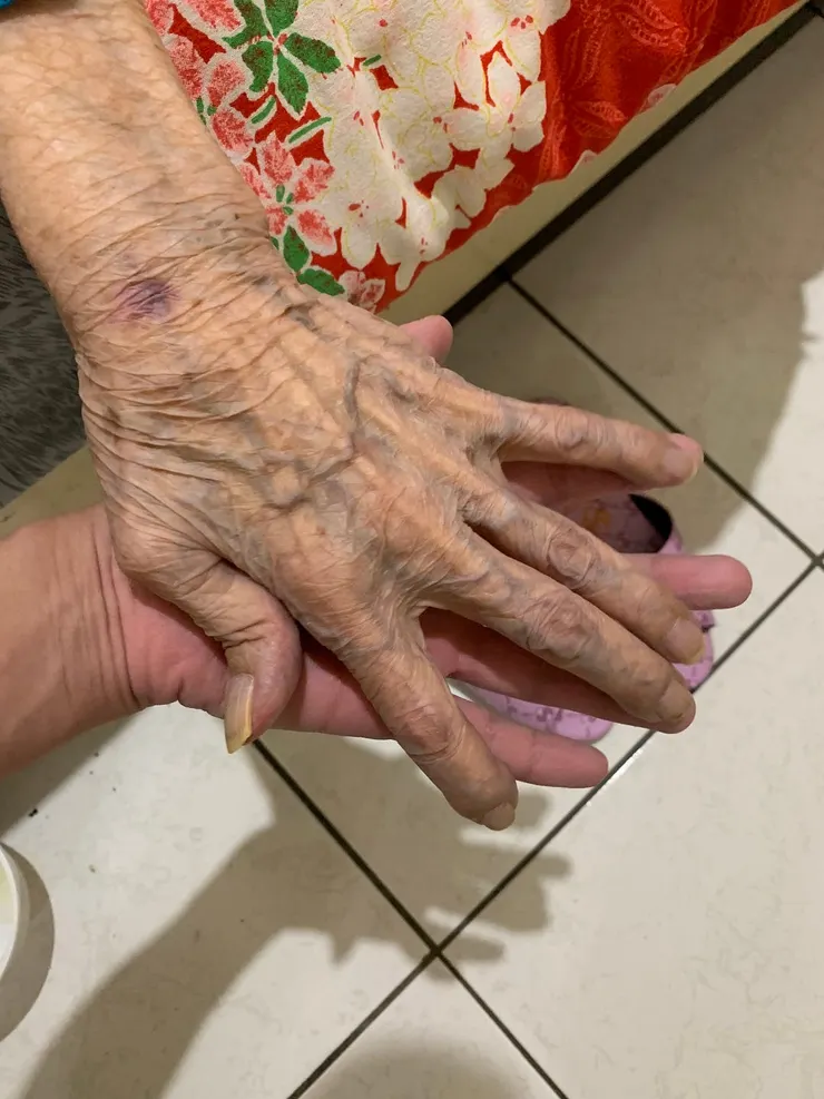 阿嬤在過世前一個禮拜身體血氧濃度降低，手腳末端失去皮膚的紅潤，而呈現暗紅。