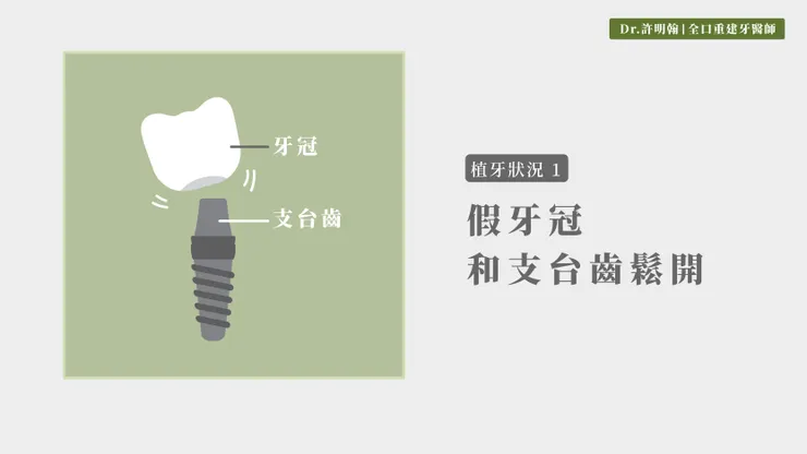 第1種植牙狀況 假牙冠鬆開