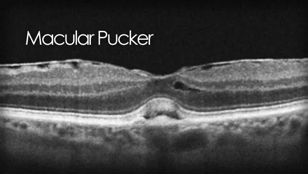Macular Pucker— Macular Center