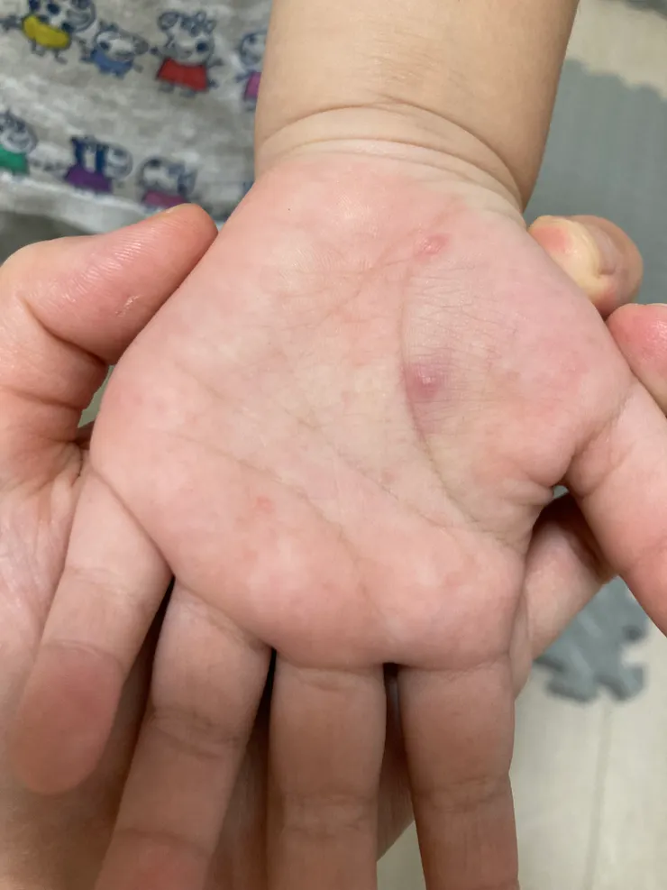 兒子手掌上出現兩顆紅腫水泡